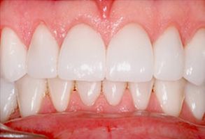 Dentistry With Comfort | Extractions, Teeth Whitening and Dental Bridges