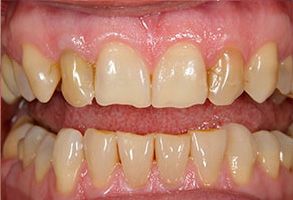 Dentistry With Comfort | Dental Fillings, Veneers and Sports Mouthguards